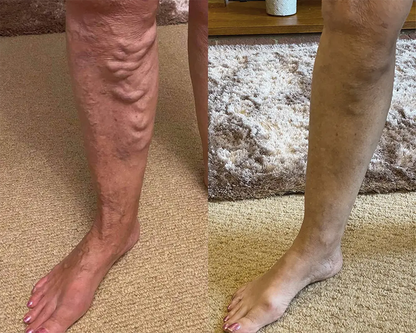 Herbal Vein Relief Spray