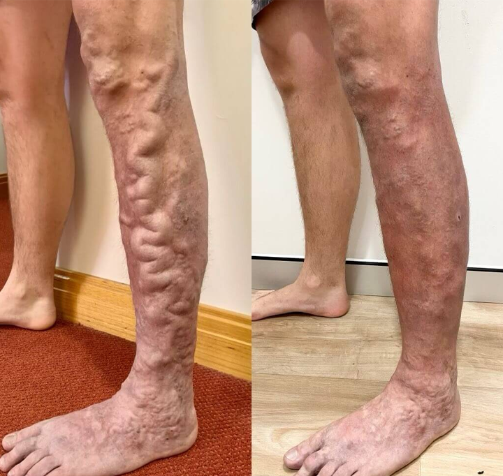 Herbal Vein Relief Spray